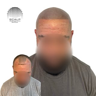 Hairline rescue! 🛟 

 #scalpmicropigmentation #smp #hairloss #hairlosstreatment #cosmetictatoo #mic