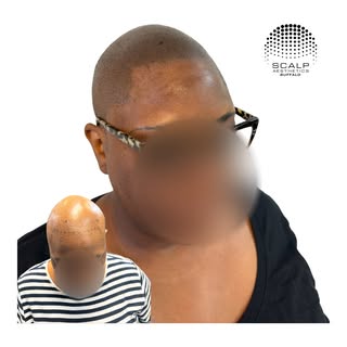 Life changing results for this female client with alopecia totalis. 

 #scalpmicropigmentation #smp 