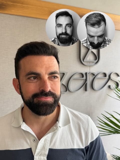 🥇 Resultado en la revisión de los 6 meses de la intervención. 
 
🌳 Máxima densidad. 

☘️ Máxima na