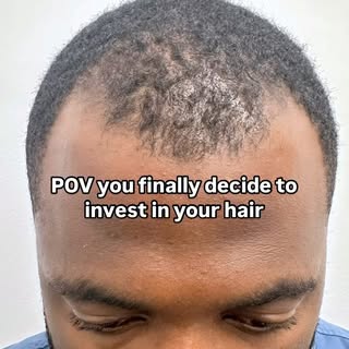 You see it as restoring a hairline, we see it as restoring confidence 💯 If you didn’t know… we do h