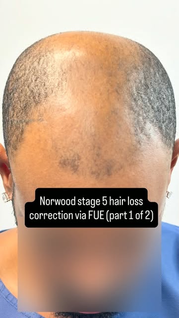 Advanced norwood stage 5 hair loss typically requires two procedures and 6000~ 7000 grafts for a goo