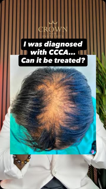 CCCA is a type of scarring alopecia that can be very emotional and traumatic for those diagnosed… BU