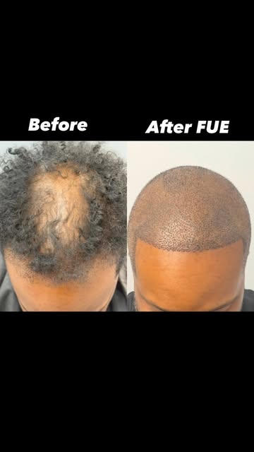 Today we corrected thinning in the hairline , midscalp and crown with a 4000 graft FUE hair transpla