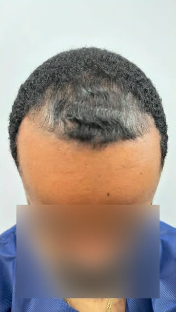 Hair restoration update … hair is coming in nicely … 3500 graft FUE to correct male pattern hairloss