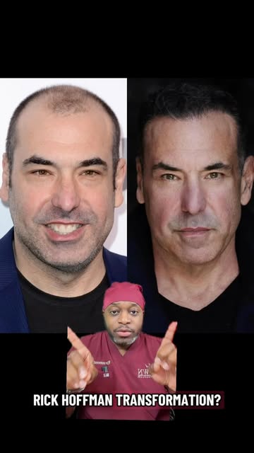 A hair transplant can do wonders regarding changing the way a person looks and boosting their self c