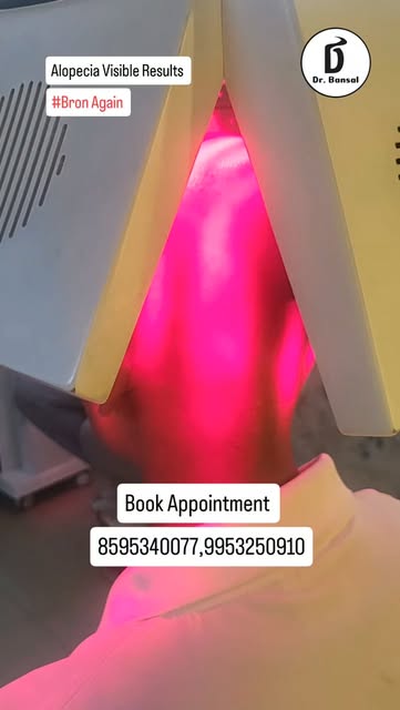 #alopeciaareata #naturalhairgrowth  #alopeciatreatment 
#hairlosstreatment