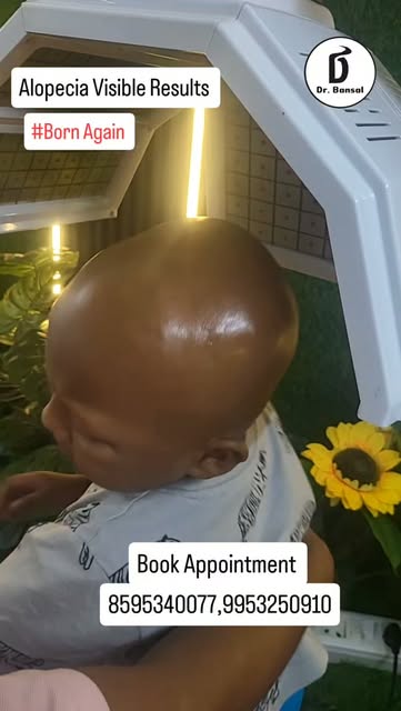 #alopeciaareata #naturalhairgrowth #hairgrowthtips #trending #alopeciatreatment