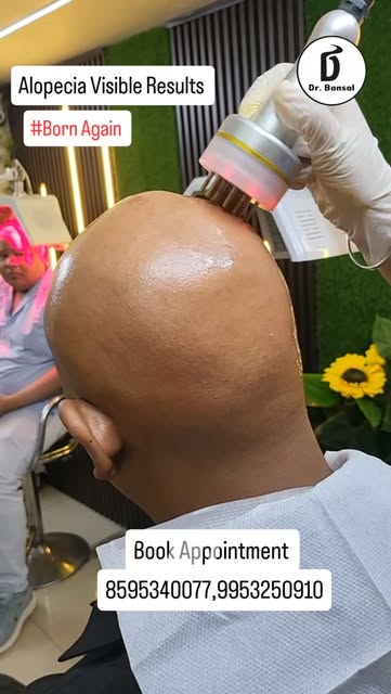 #alopeciaareata #naturalhairgrowth #hairgrowthtips #trending