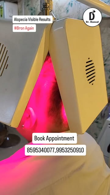 #alopeciaareata #naturalhairgrowth #hairgrowthtips #alopeciatreatment #trending