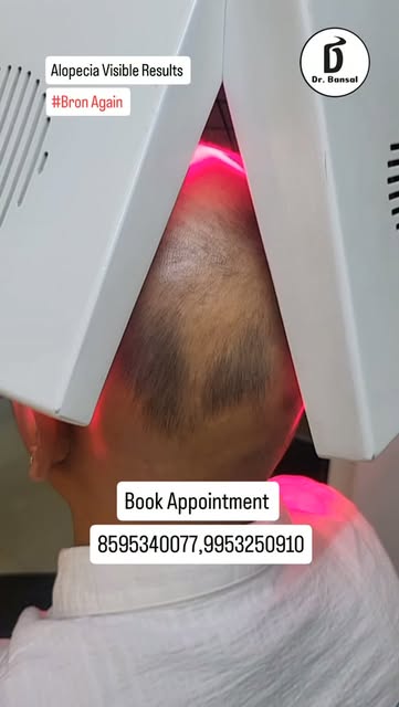 #alopeciaareata #naturalhairgrowth #hairgrowthtips #trending #alopeciatreatment