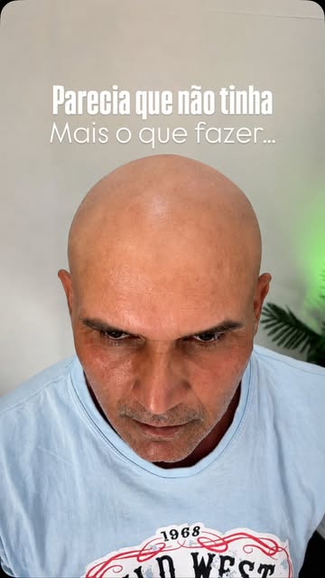 Parecia que não tinha mais o que fazer. Até ele decidir fazer diferente.

A calvície avançada muitas