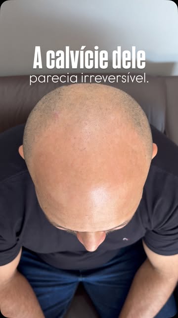 A calvície pode mudar a forma como você se enxerga mas não precisa definir sua aparência.

Neste cas