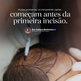 Nem todo erro no transplante capilar acontece na execução.
Na verdade, os mais difíceis de corrigir…
