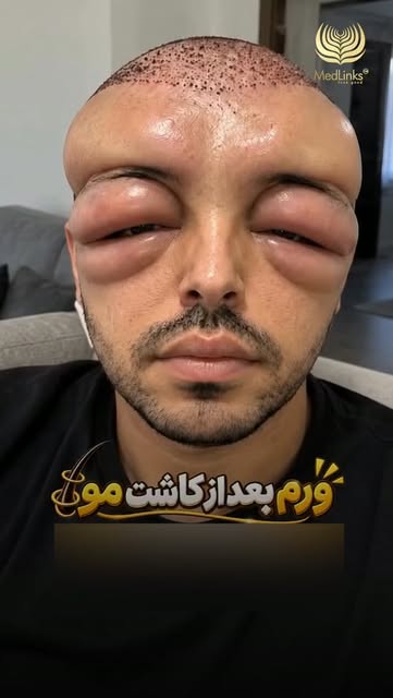 Can your face really swell like THIS after a hair transplant? 😳
This video has been circulating onl