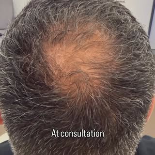 Crown restoration is one of the most technically demanding areas in hair transplantation.

Unlike th