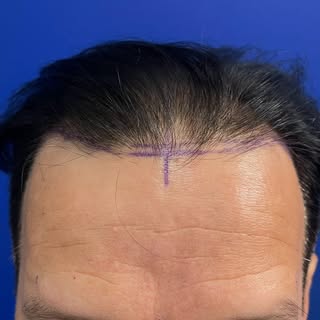 The most important part of a hair transplant is often the part patients never see—the planning.

Eve
