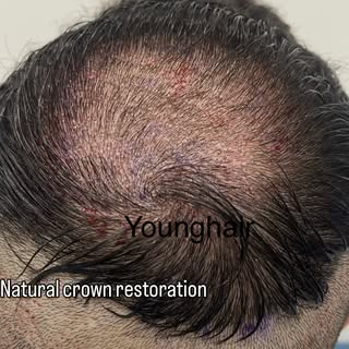 Natural crown restoration.

A natural crown doesn’t happen by chance.
The crown is one of the most t