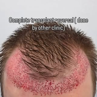 What is a Hair Transplant Reversal?

Sometimes the path to a natural hairline is not adding more gra