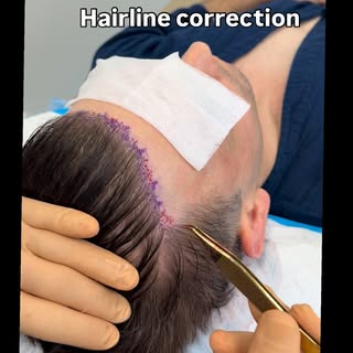 Hairline Correction: When More Hair Isn’t Better

This patient presented after a previous hair trans
