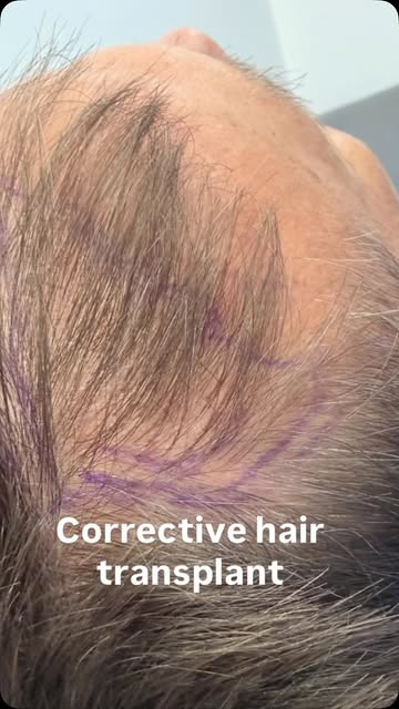 How many problems can you identify in this hairline?

Today, we’re correcting a hair transplant perf
