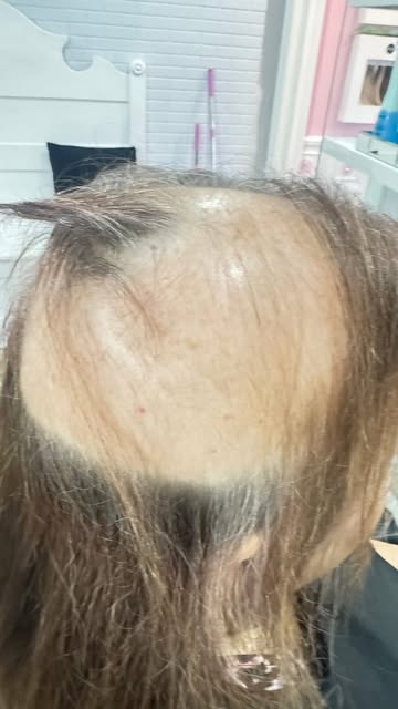 What can you say... this was SO wonderful to do!! This is what Im truly passionate about ! #hairloss