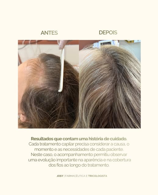 Nem todo resultado acontece de uma hora para outra.
Na tricologia, acompanhar a evolução é tão impor