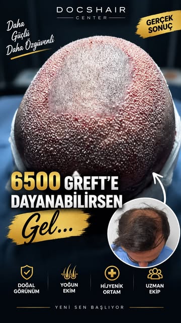 ✨ Doğal görünüm, doğru planlama ile başlar.

Saç ekimi yalnızca kaybolan saçların yerine greft yerle