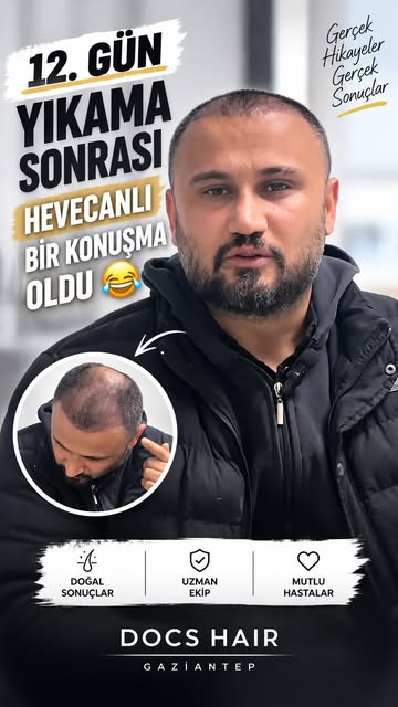 ✨ Doğal görünüm, doğru planlama ile başlar.

Saç ekimi yalnızca kaybolan saçların yerine greft yerle