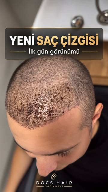 ✨ Doğal görünüm, doğru planlama ile başlar.

Saç ekimi yalnızca kaybolan saçların yerine greft yerle