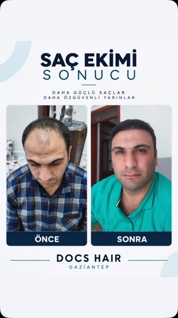 ✨ Doğal görünüm, doğru planlama ile başlar.

Saç ekimi yalnızca kaybolan saçların yerine greft yerle