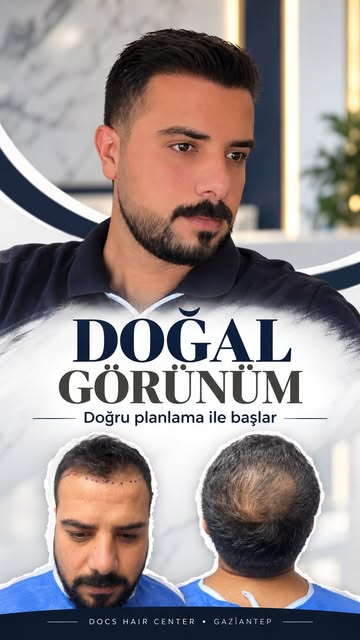 ✨ Doğal görünüm, doğru planlama ile başlar.

Saç ekimi yalnızca kaybolan saçların yerine greft yerle