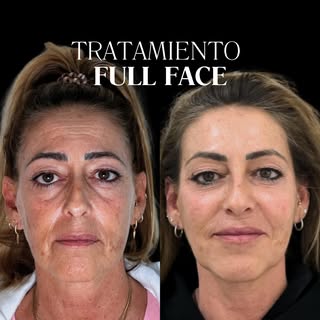 ⭐️Full Face y Rejuvenecimiento Facial⭐️

Te presento este caso muy interesante: Es un tratamiento pe