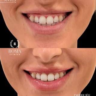 ¿Al sonreír muestras más encía de la que te gustaría? 

En muchos casos, la sonrisa gingival puede t