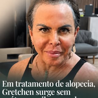 A queda de cabelo pode ter diferentes causas e a alopecia é uma delas. 

O caso da Gretchen chama at