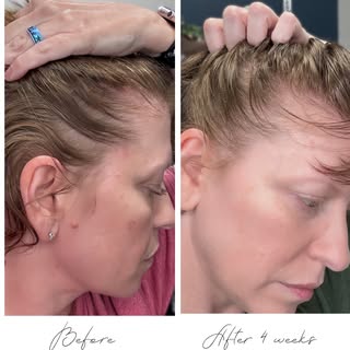 One month update:
I’ve been using the Zenagen Revolve shampoo, conditioner, and serum for one month 