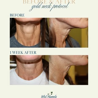 The Gold Neck Protocol in action. ✨

By combining Radiesse®, Belotero® and Xeomin®, this non-surgica