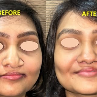 27 Years of Trust: A Lifetime Reconstructive Journey ✨
Swipe to see the power of definitive rhinopla