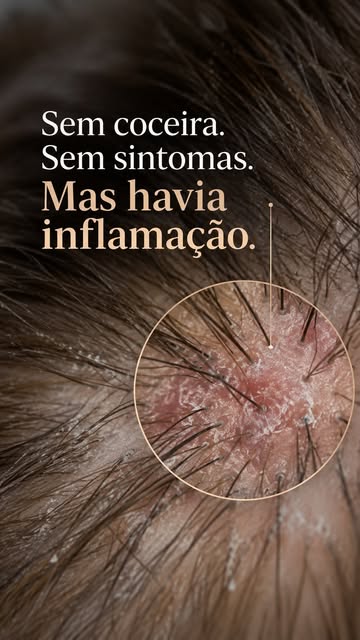 Nem toda inflamação do couro cabeludo causa coceira ou descamação visível.
Nesse caso, o que chamou 