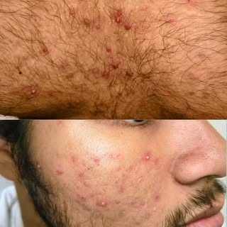   “Why Do Pimples Keep Coming Back? Face + Back + Chest Acne Before & After”  

This patient had acn