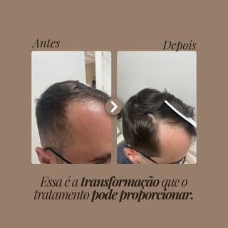 Resultado que enche os olhos ✨
✔ Estrutura do fio fortalecida
✔ Oleosidade controlada
✔ Mais densida