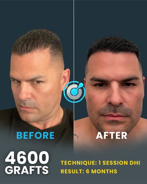 A result that speaks for itself.

Natural hairline, full density, and a patient who’s finally confid