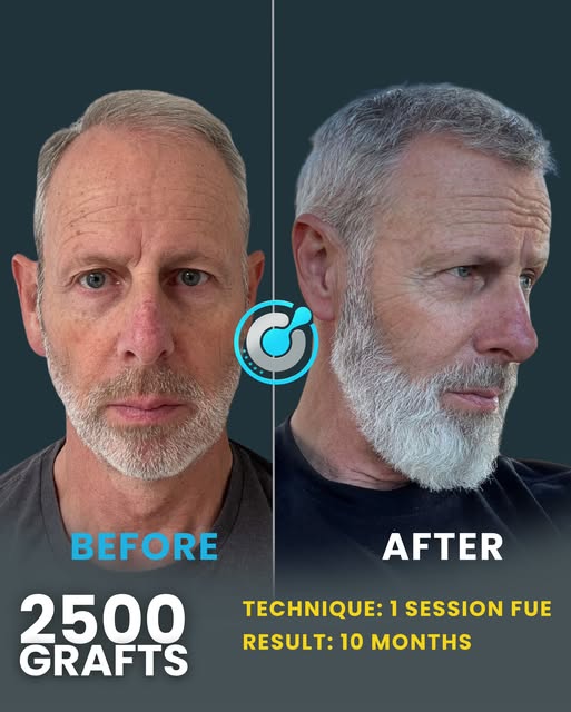 From insecure to unstoppable.
Swipe to see the difference precision and expertise can make. Every gr