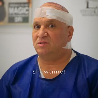 Angelo came in for his hair transplant and honestly his results are going to be incredible.

We used