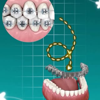 Straighten your smile the smart way 😁✨
No metal braces. No painful wires. Just advanced Invisalign 