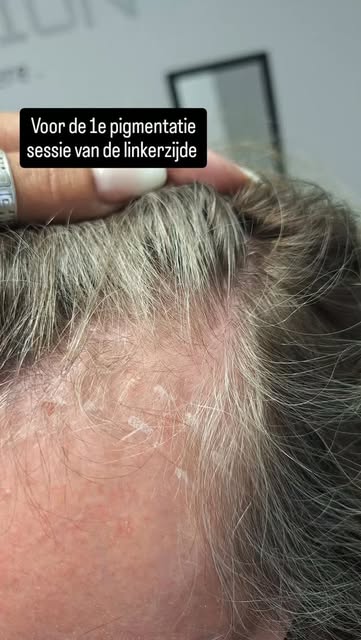 MHP bij diepe, kalende inhammen | sessie 1 ✨

Deze dame heeft diepe, kalende inhammen die we met MHP