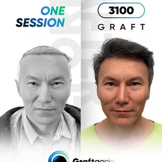 Nur 6 Monate nach der Haartransplantation mit 3100 Grafts – das Ergebnis spricht für sich! 🔥✨
Graft
