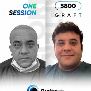 🔥 5800 Grafts in ONE Session
Maximale Dichte. Natürliches Ergebnis.

Bei Graftgenix führen wir prof