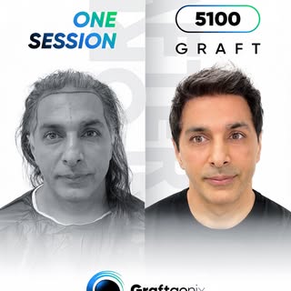 5100 Grafts. 1 Sitzung. Maximale Dichte. 🔥

Von dünn zu dicht – mit einer natürlichen Haarlinie, di