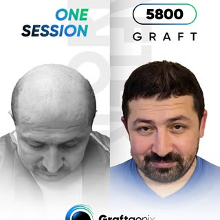 Wenn du denkst, dass es für deine Haare zu spät ist – schau dir dieses Ergebnis an.

5800 Grafts. 1 
