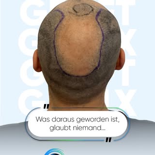 Wenn du nur den Anfang sehen würdest, würdest du niemals an dieses Ergebnis glauben.
Starker Haaraus